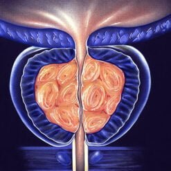 Benign prostatic hyperplasia