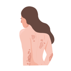 Psoriasis